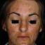 4. Chloasma on Face Pictures