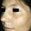 7. Chloasma on Face Pictures