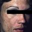 10. Melasma on Face Pictures