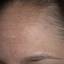 14. Melasma on Face Pictures