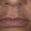 15. Melasma on Face Pictures