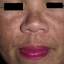 16. Melasma on Face Pictures
