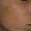 18. Melasma on Face Pictures
