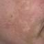 20. Melasma on Face Pictures