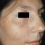 4. Melasma on Face Pictures