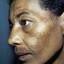 7. Melasma on Face Pictures