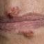 10. Herpes Pictures