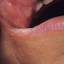 16. Herpes Pictures
