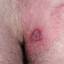 18. Herpes Pictures