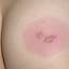 19. Herpes Pictures