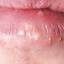 2. Herpes Pictures