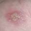 21. Herpes Pictures