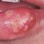 3. Herpes Pictures