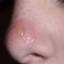 31. Herpes Pictures