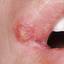 34. Herpes Pictures