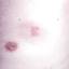36. Herpes Pictures
