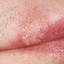 4. Herpes Pictures