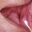 43. Herpes Pictures
