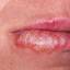 45. Herpes Pictures