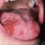 48. Herpes Pictures