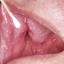 49. Herpes Pictures