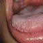 50. Herpes Pictures