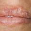 6. Herpes Pictures