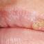 9. Herpes Pictures