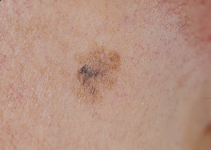 Lentigo Melanoma Pictures – 29 Photos & Images / illnessee.com