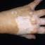1. Vitiligo Spots Pictures