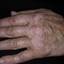 10. Vitiligo Spots Pictures