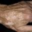 14. Vitiligo Spots Pictures