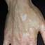 15. Vitiligo Spots Pictures