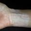 16. Vitiligo Spots Pictures