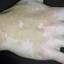 17. Vitiligo Spots Pictures