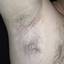 20. Vitiligo Spots Pictures