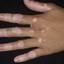 22. Vitiligo Spots Pictures