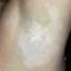 25. Vitiligo Spots Pictures