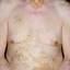 26. Vitiligo Spots Pictures