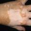 28. Vitiligo Spots Pictures