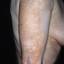 3. Vitiligo Spots Pictures