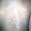 32. Vitiligo Spots Pictures