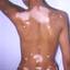 34. Vitiligo Spots Pictures