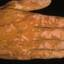 36. Vitiligo Spots Pictures