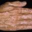 37. Vitiligo Spots Pictures