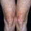 4. Vitiligo Spots Pictures
