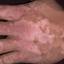 41. Vitiligo Spots Pictures