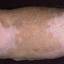 42. Vitiligo Spots Pictures