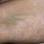 43. Vitiligo Spots Pictures