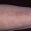 44. Vitiligo Spots Pictures